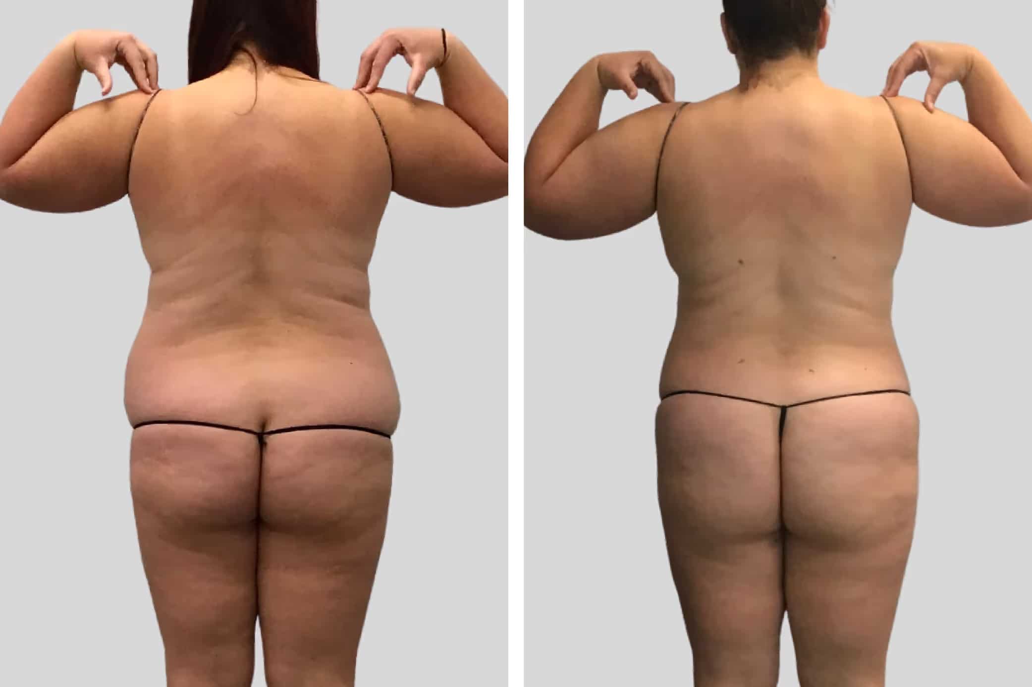Before and After Image: Flanks and Back - back