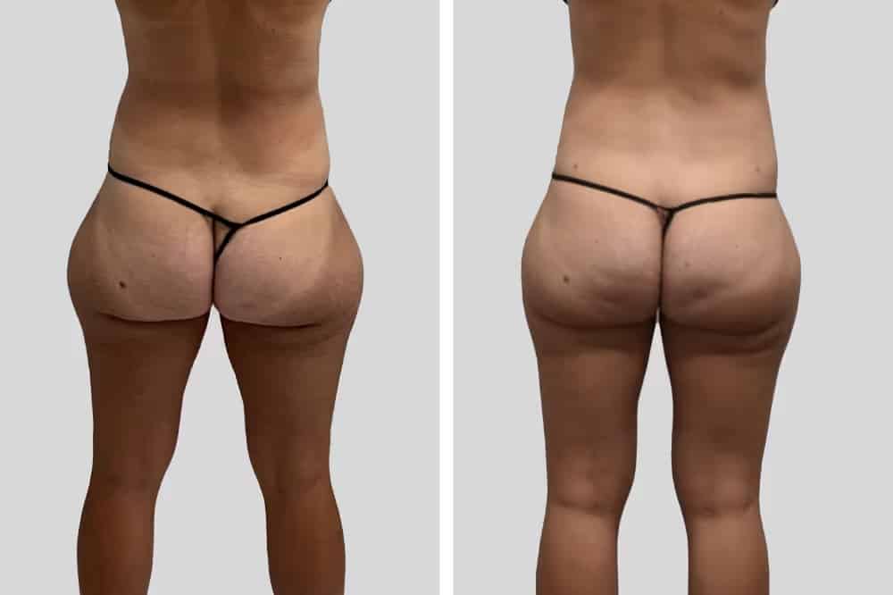 Before and After Image: Hips - back