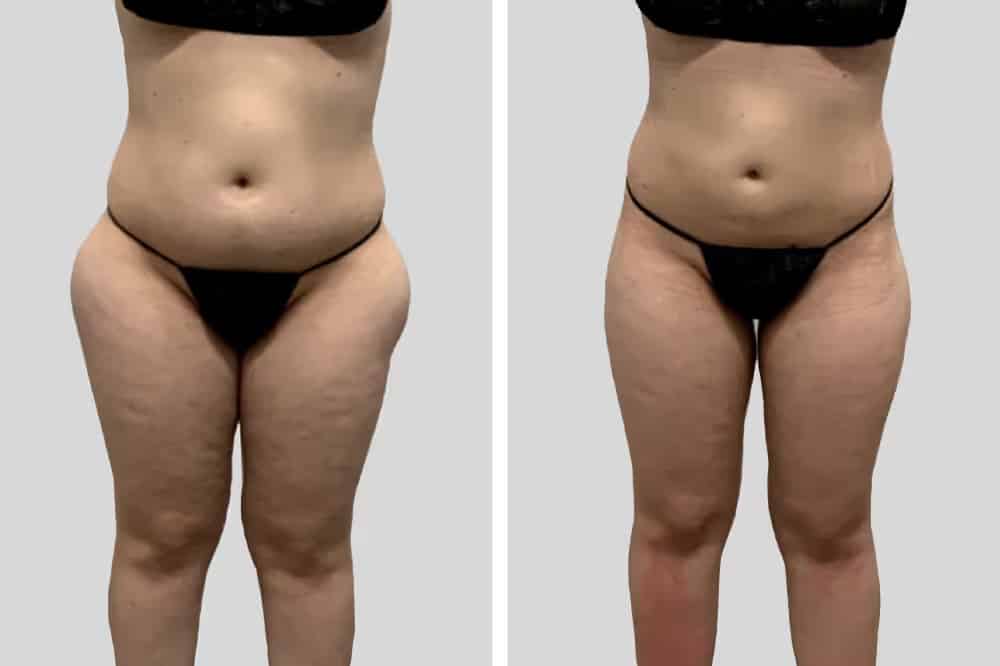 Before and After Image: Hips - front
