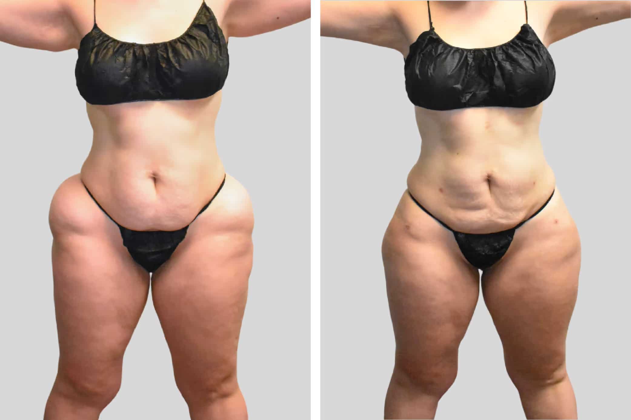 Before and After Image: Hips - front