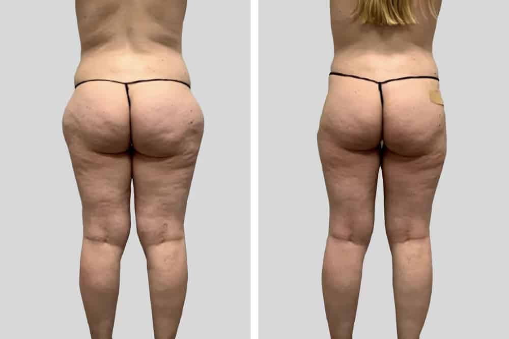 Before and After Image: Hips - back