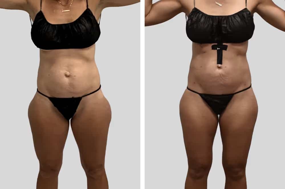 Before and After Image: Hips - front