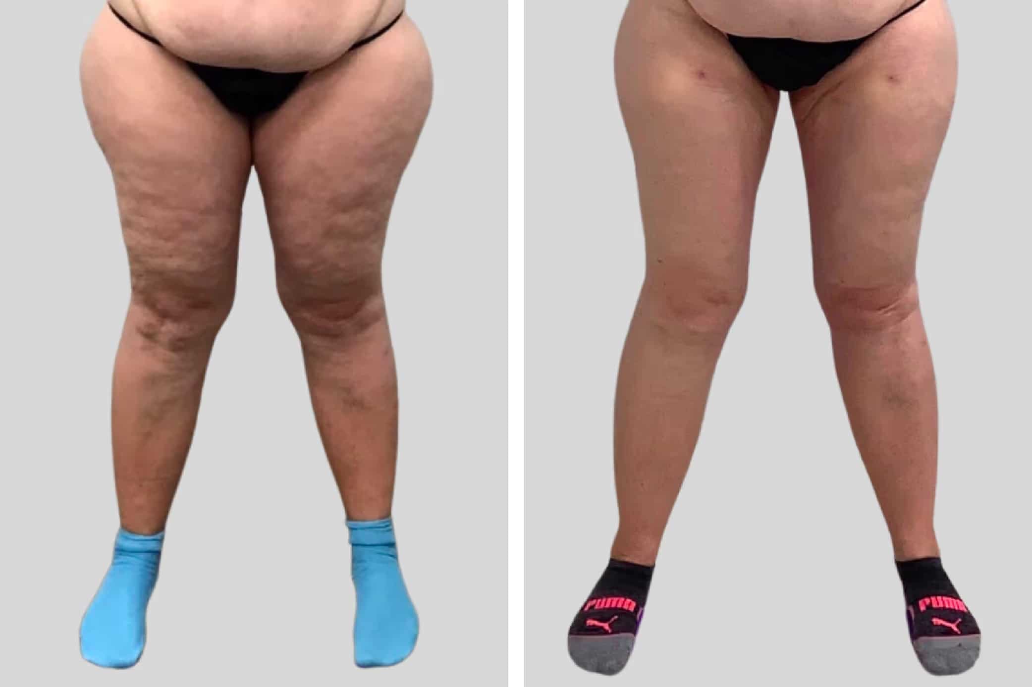 Before and After Image: Leg Sculpting - front
