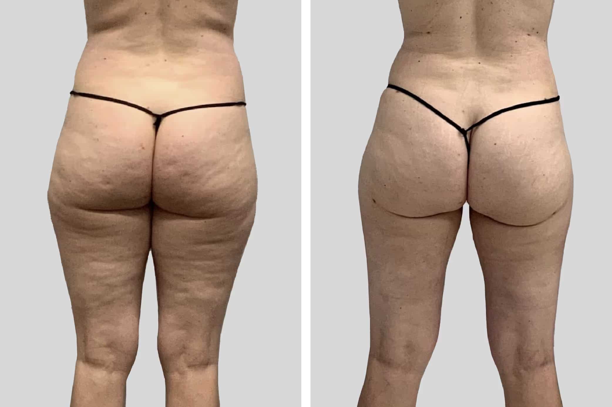 Before and After Image: Leg Sculpting - back