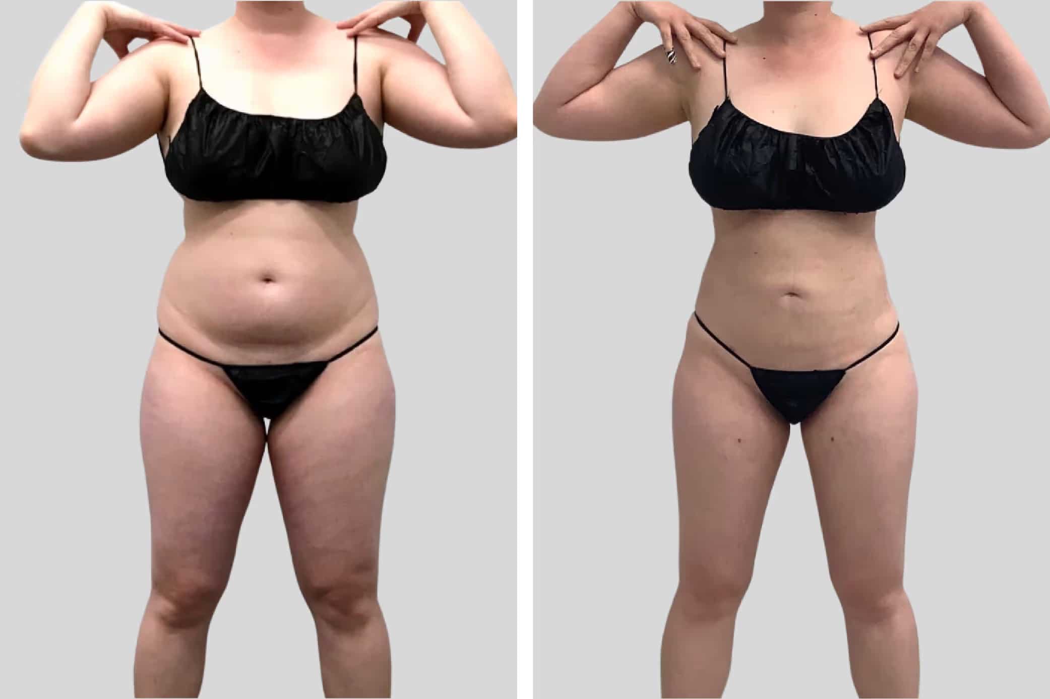 Before and After Image: Leg Sculpting - front