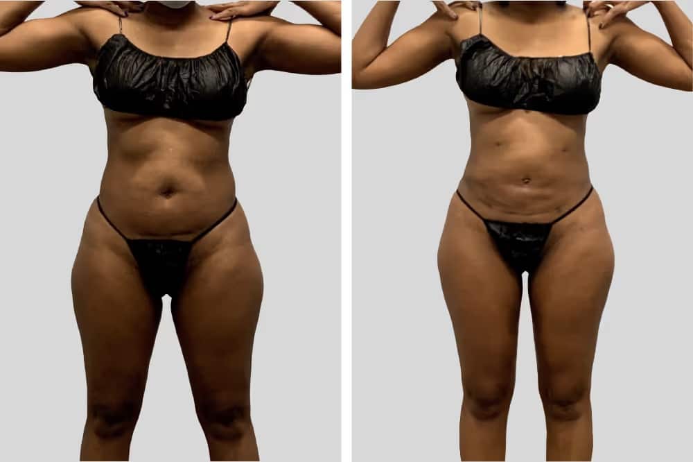 Before and After Image: Leg Sculpting - front