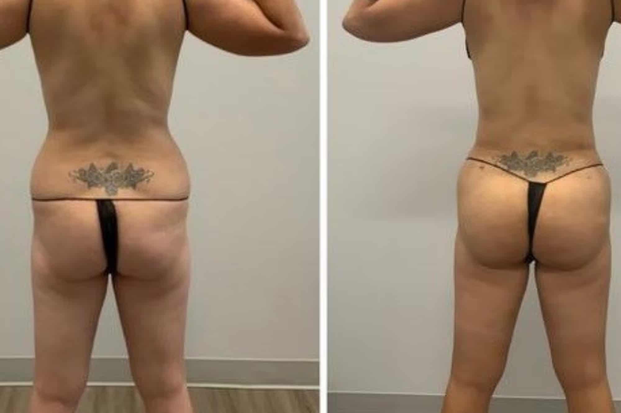 Before and After Image: Natural BBL - back