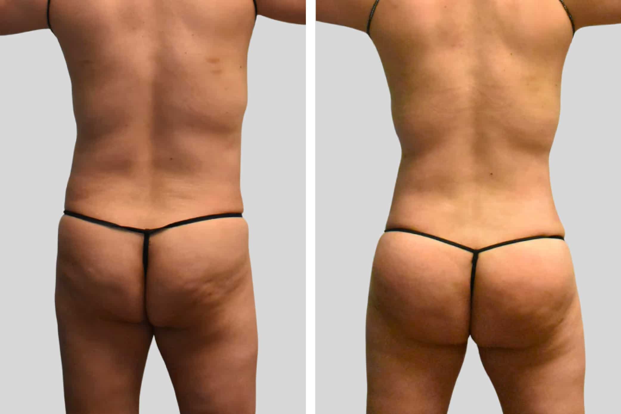 Before and After Image: Natural BBL - back