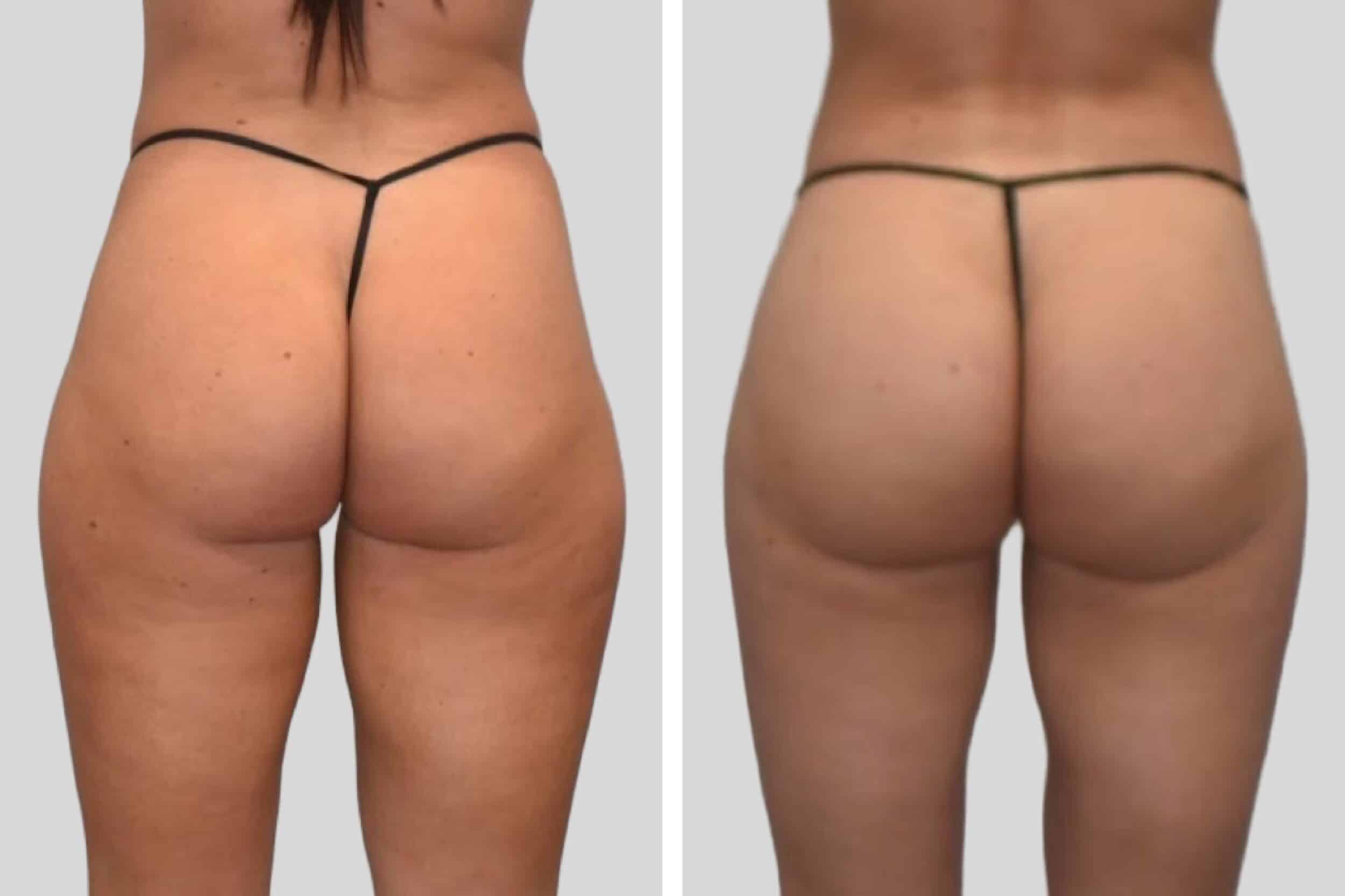 Before and After Image: Natural BBL - back