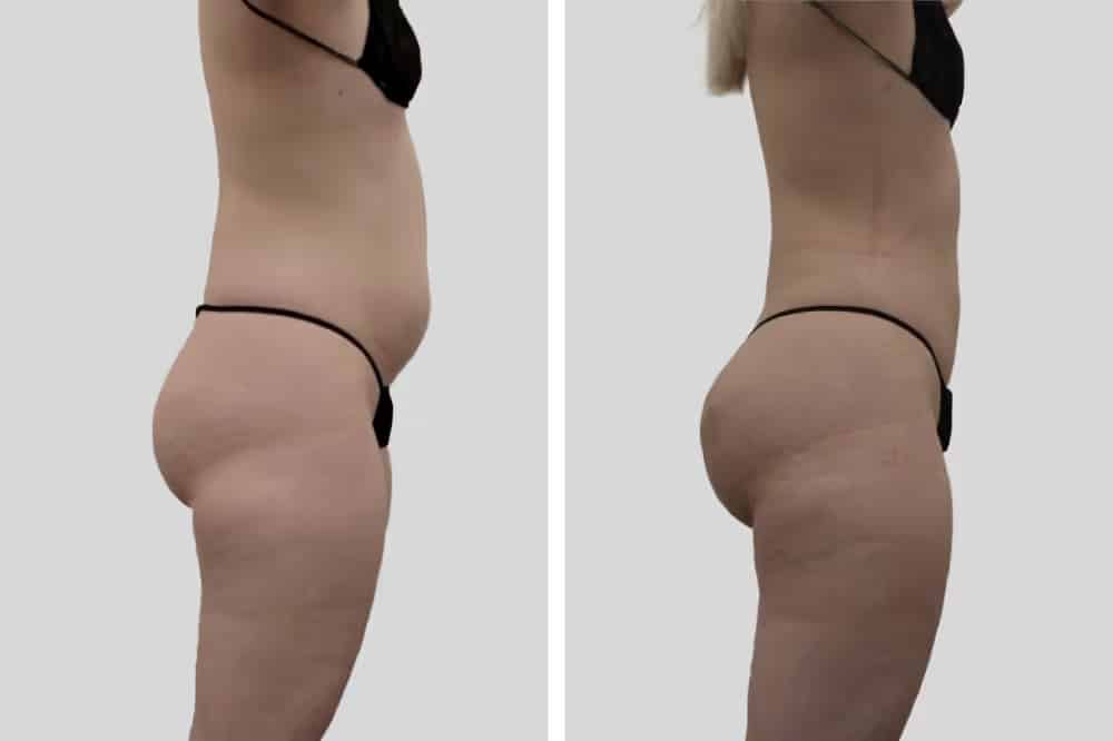 Before and After Image: Natural BBL - right-side