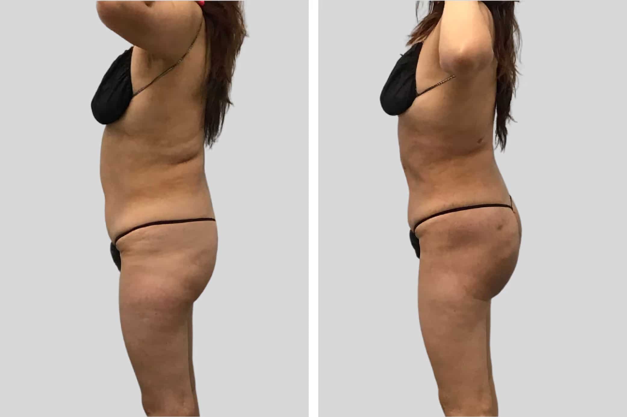 Before and After Image: Natural BBL - left-side