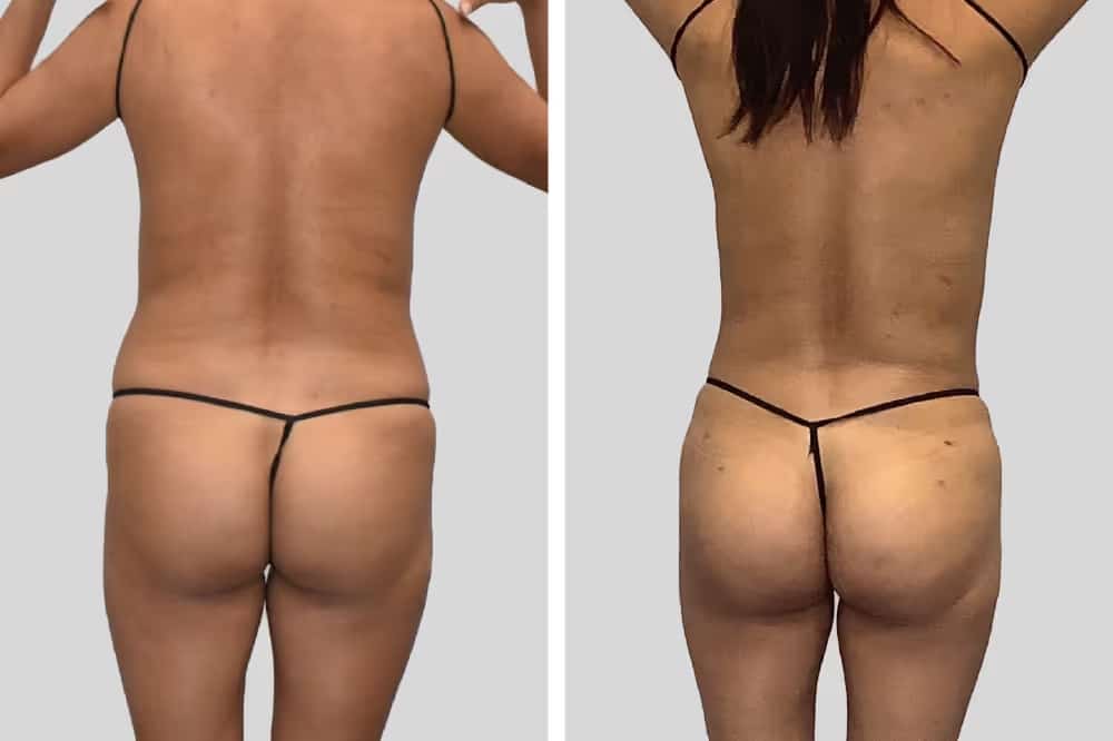 Before and After Image: Natural BBL - back