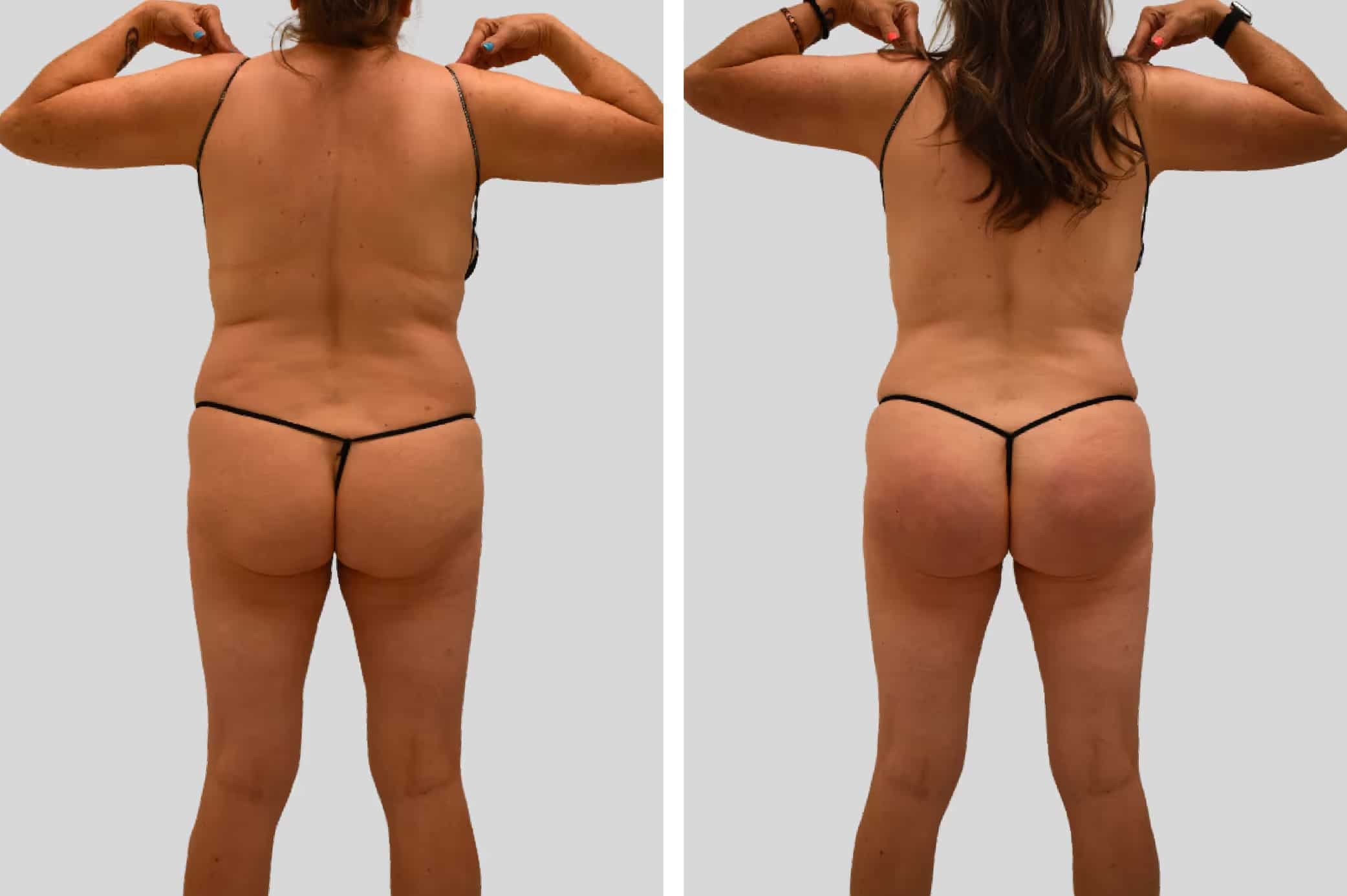 Before and After Image: Natural BBL - back