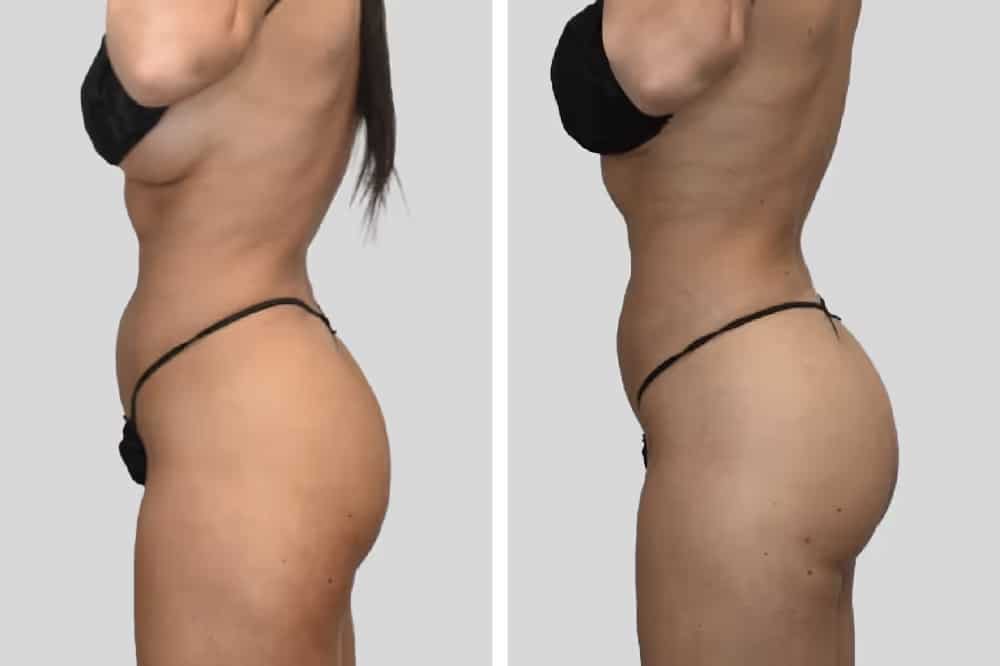 Before and After Image: Natural BBL - left-side
