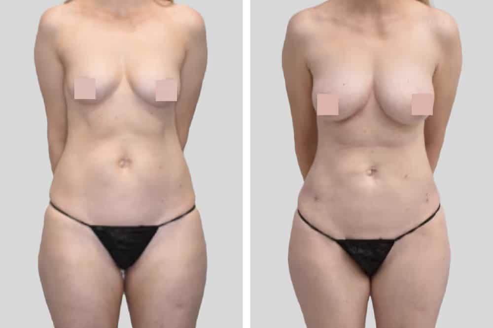 Before and After Image: Natural Fat Transfer - front