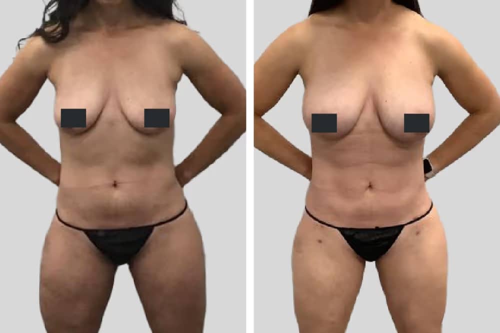 Before and After Image: Natural Fat Transfer - front