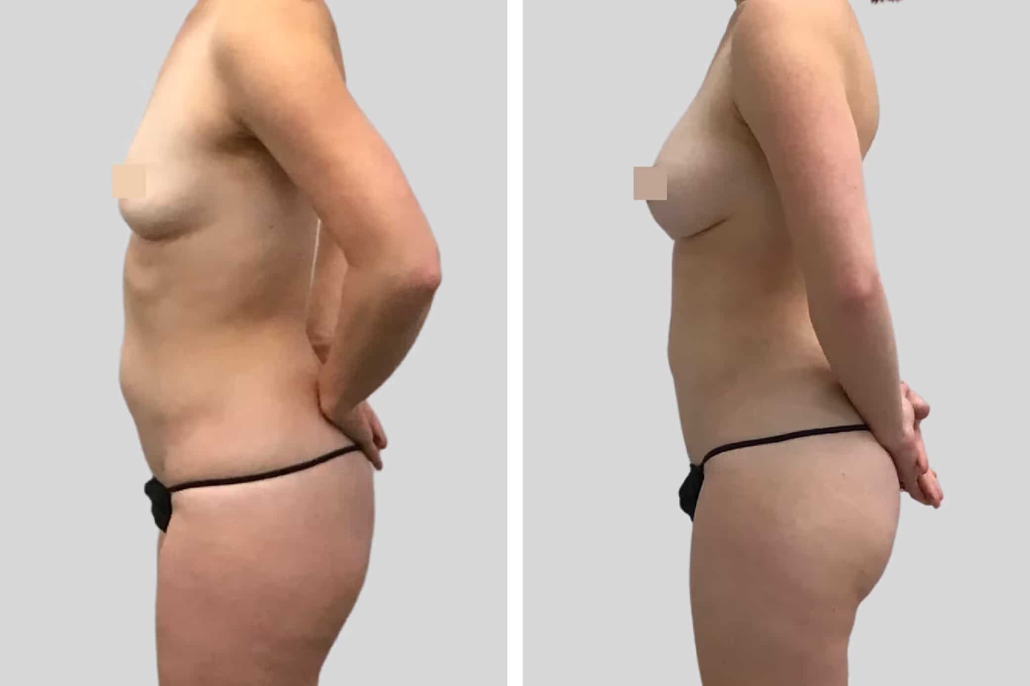 Before and After Image: Natural Fat Transfer - left-side