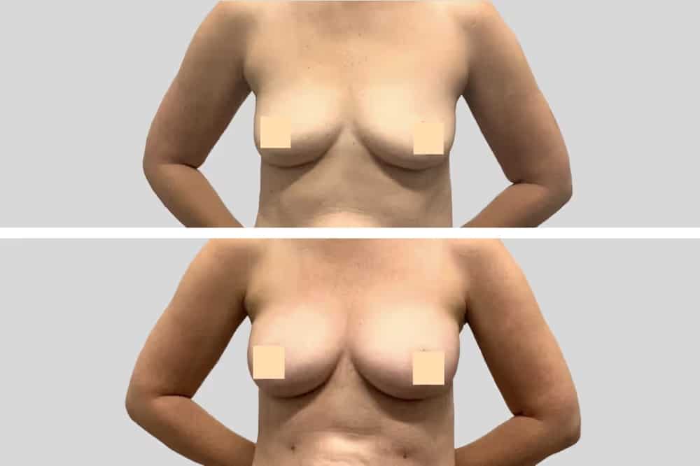 Before and After Image: Natural Fat Transfer - front