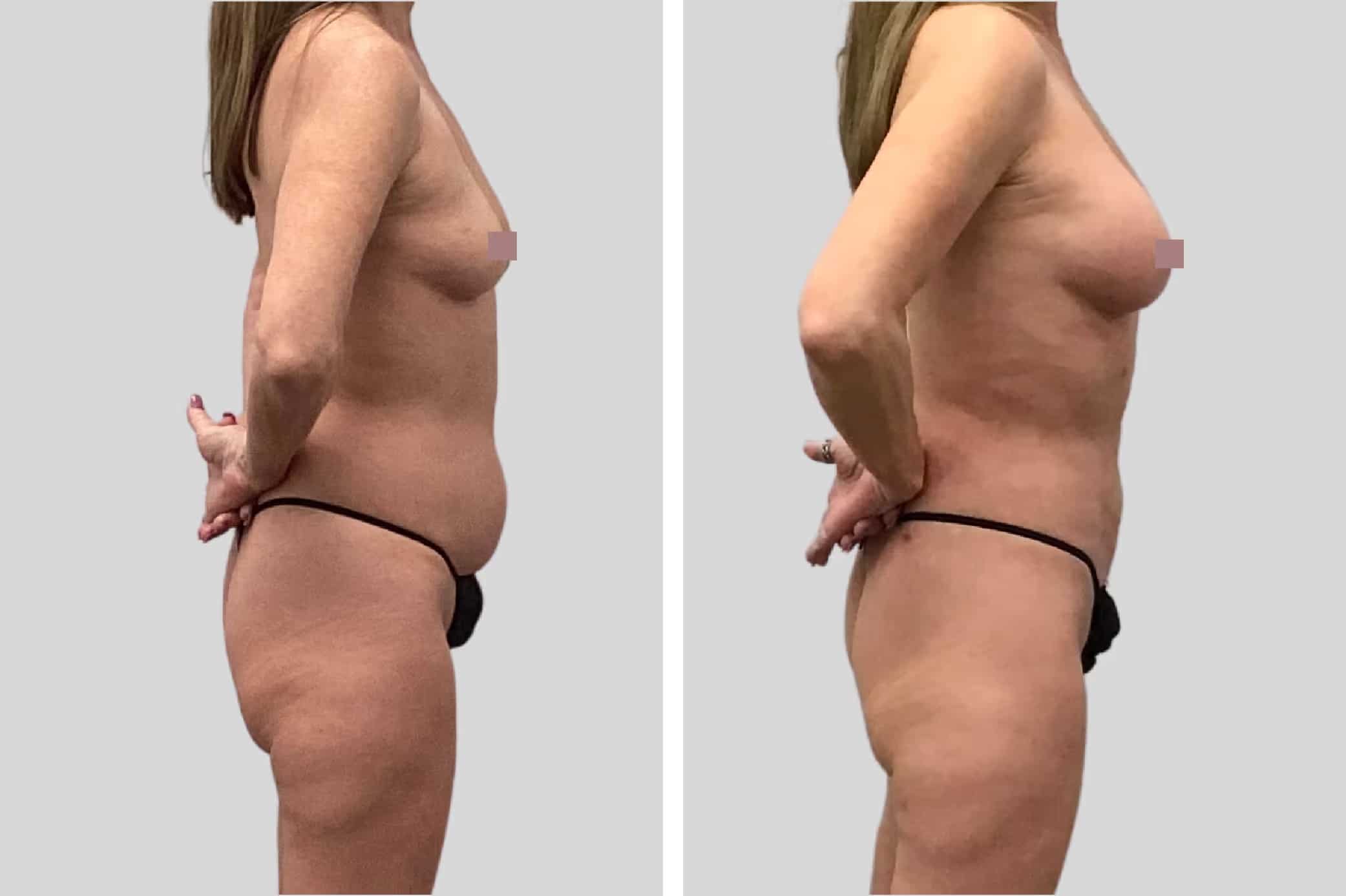 Before and After Image: Natural Fat Transfer - right-side