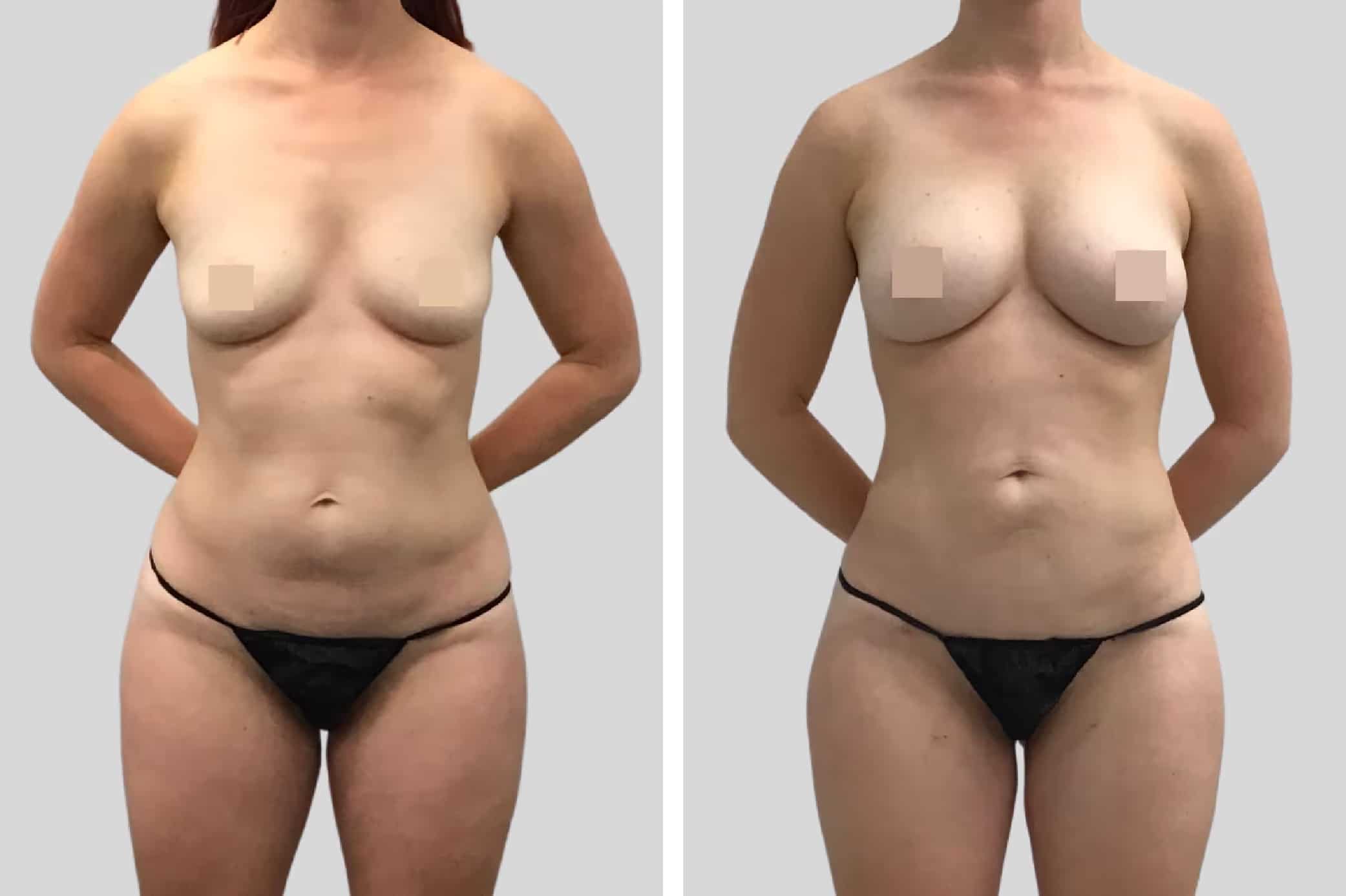Before and After Image: Natural Fat Transfer - front