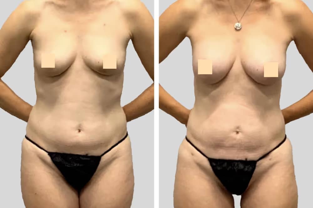 Before and After Image: Natural Fat Transfer - front