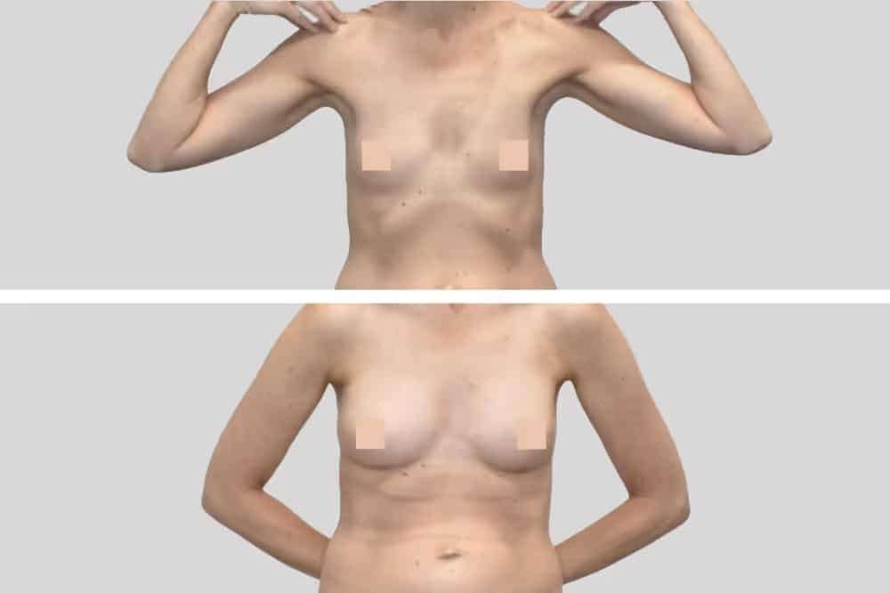 Before and After Image: Natural Fat Transfer - front