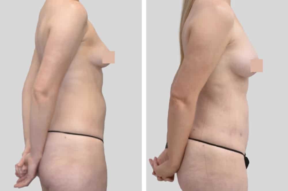 Before and After Image: Natural Fat Transfer - right-side
