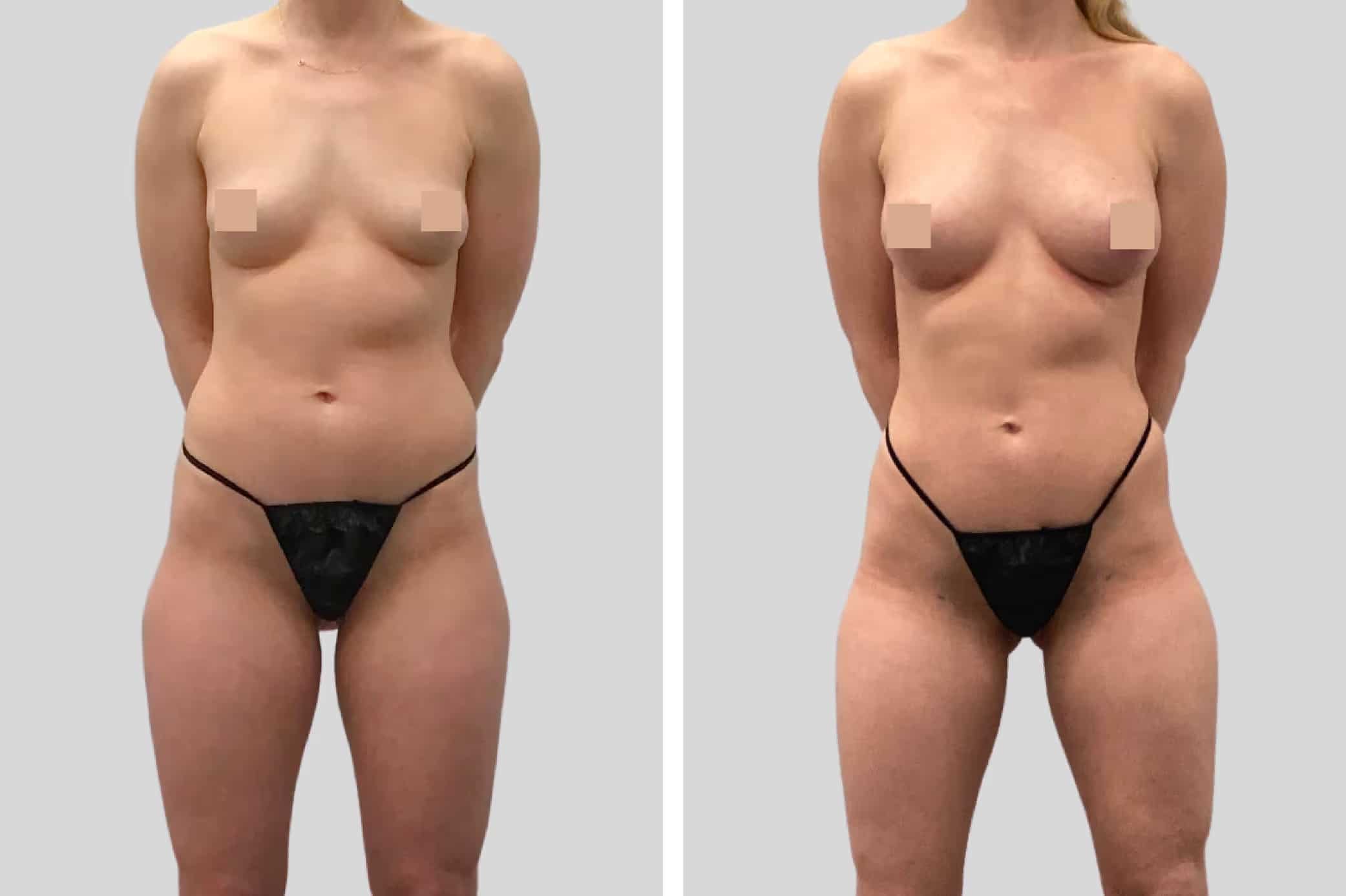 Before and After Image: Natural Fat Transfer - front