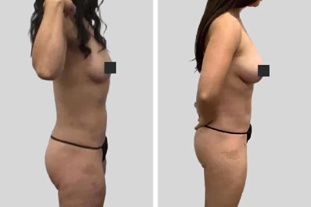 Before and After Image: Natural Fat Transfer - right-side