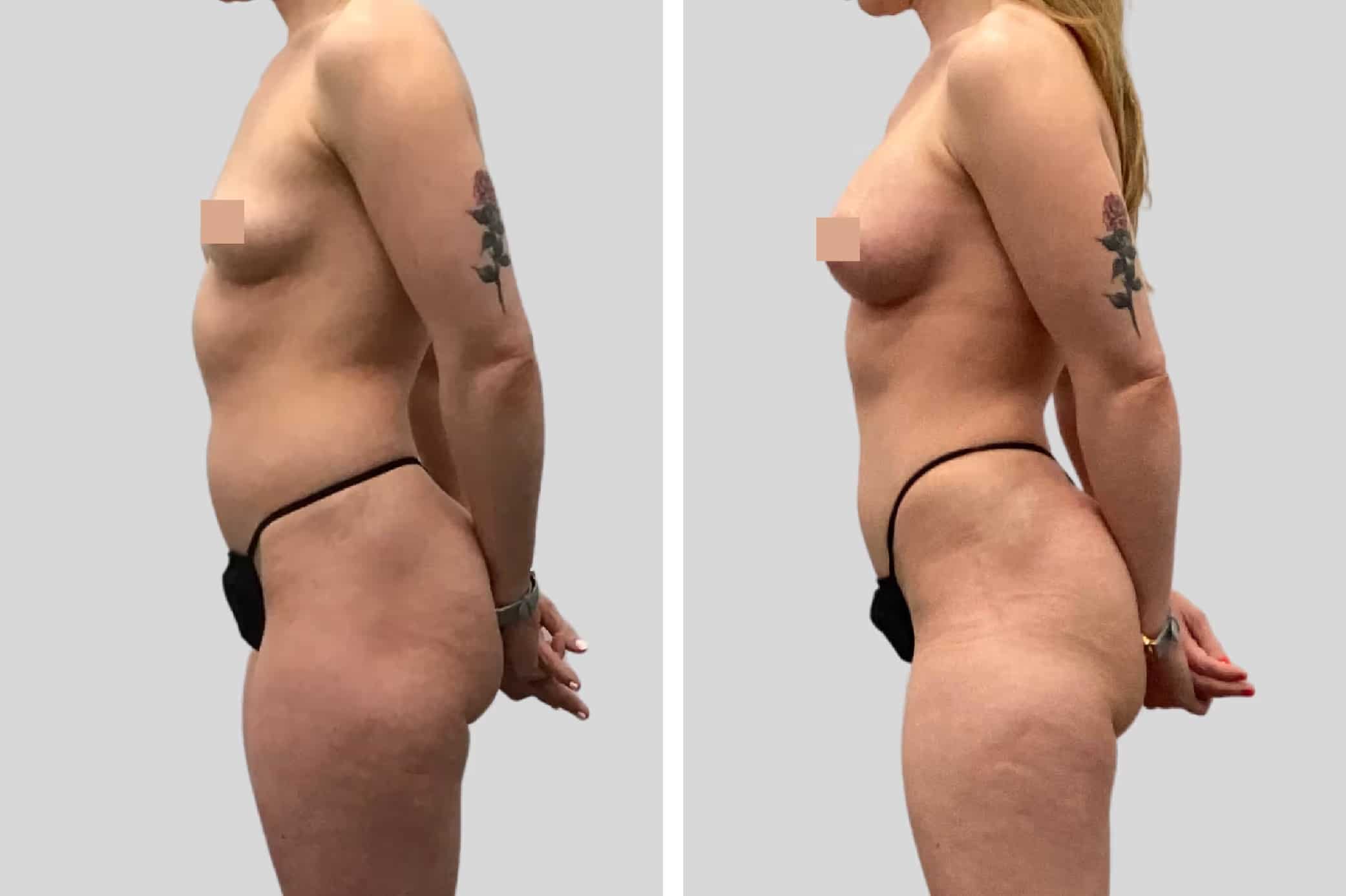 Before and After Image: Natural Fat Transfer - left-side