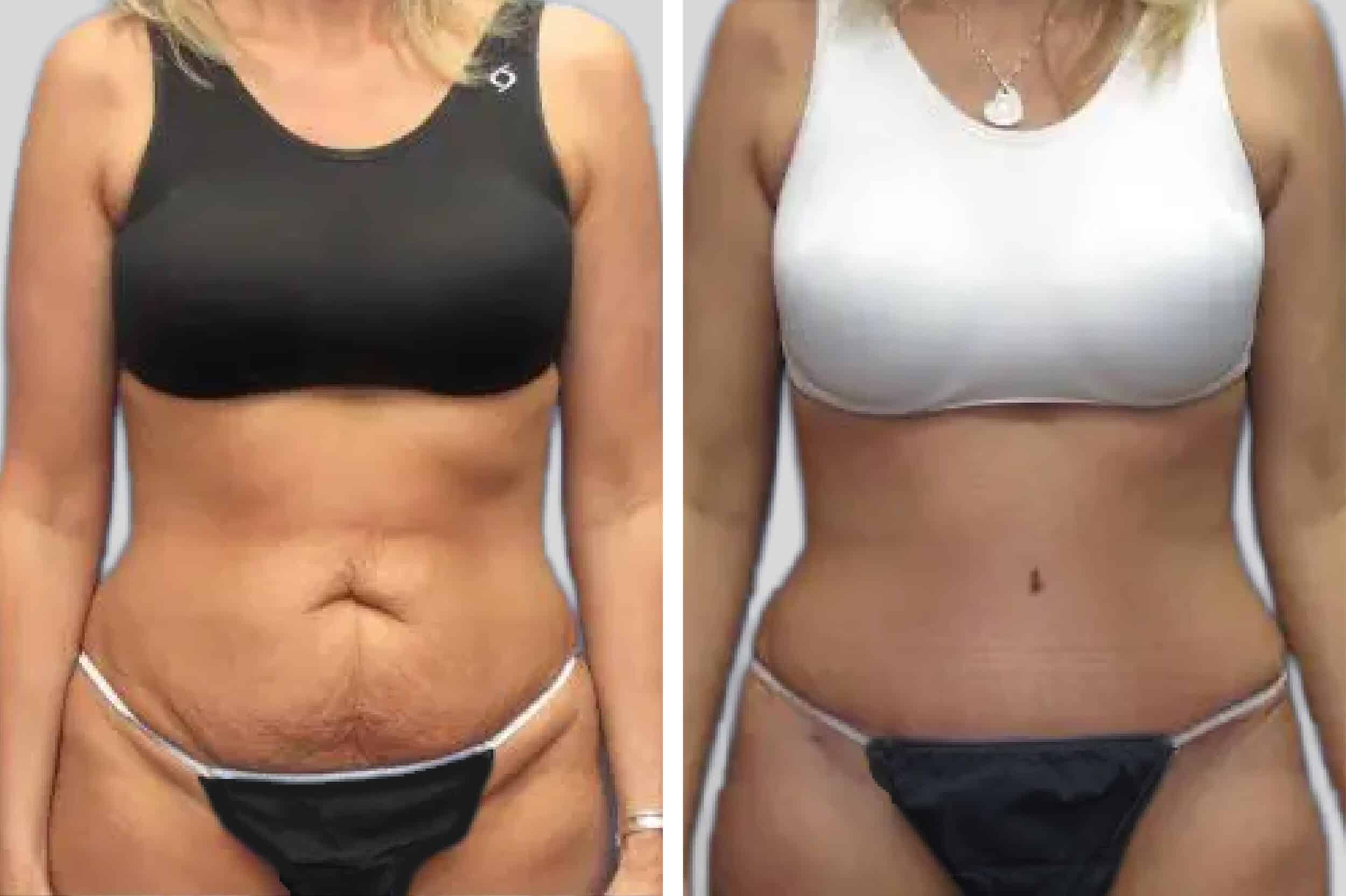 Before and After Image: Tummy Tuck - front