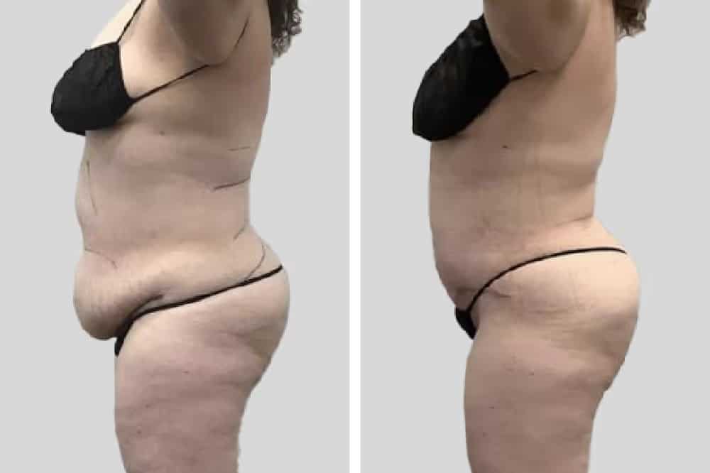 Before and After Image: Tummy Tuck - left-side