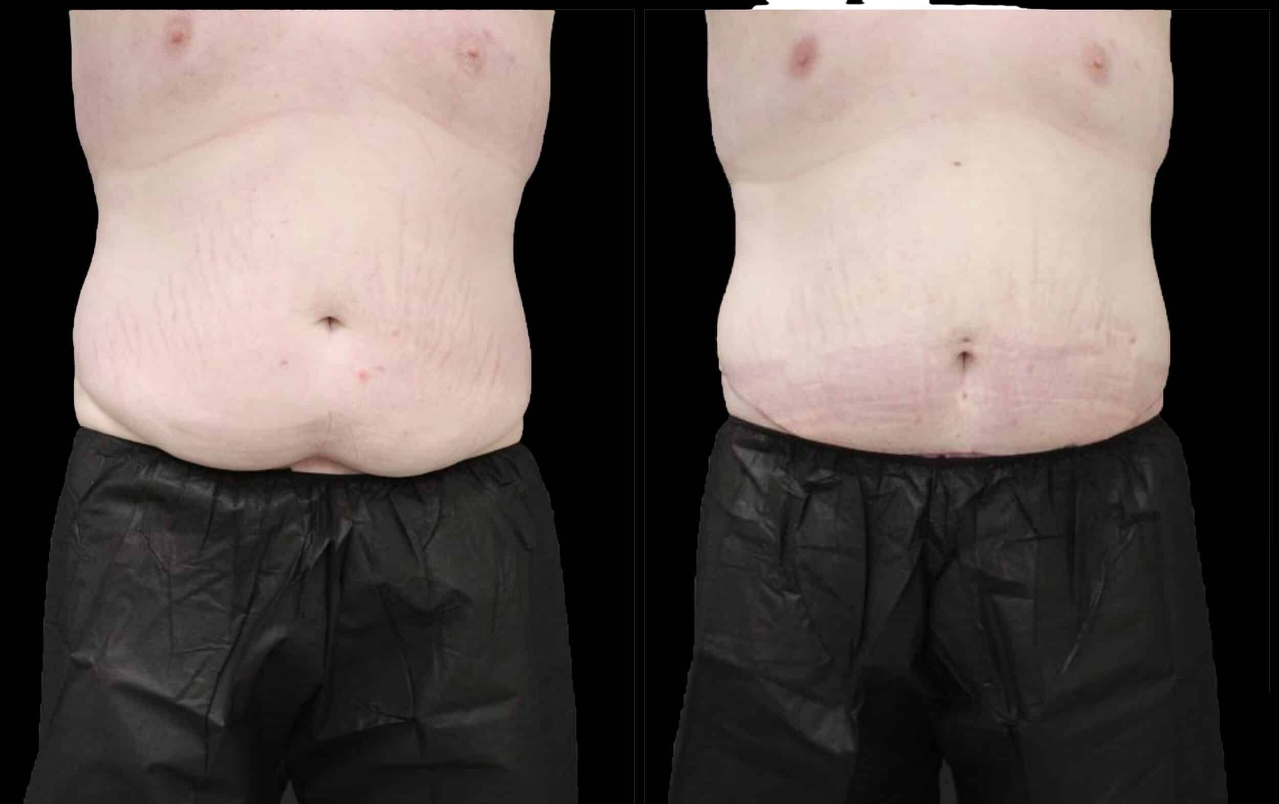 Before and After Image: Tummy Tuck - front