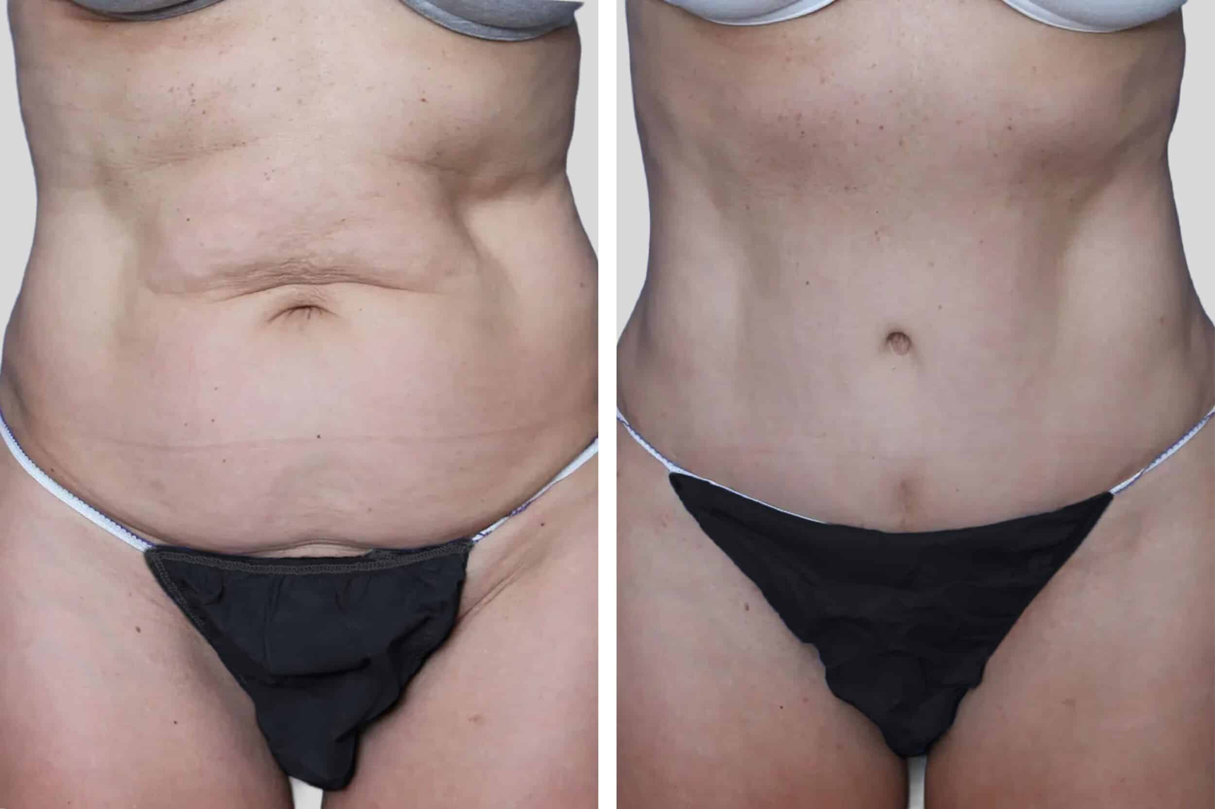 Before and After Image: Tummy Tuck - front