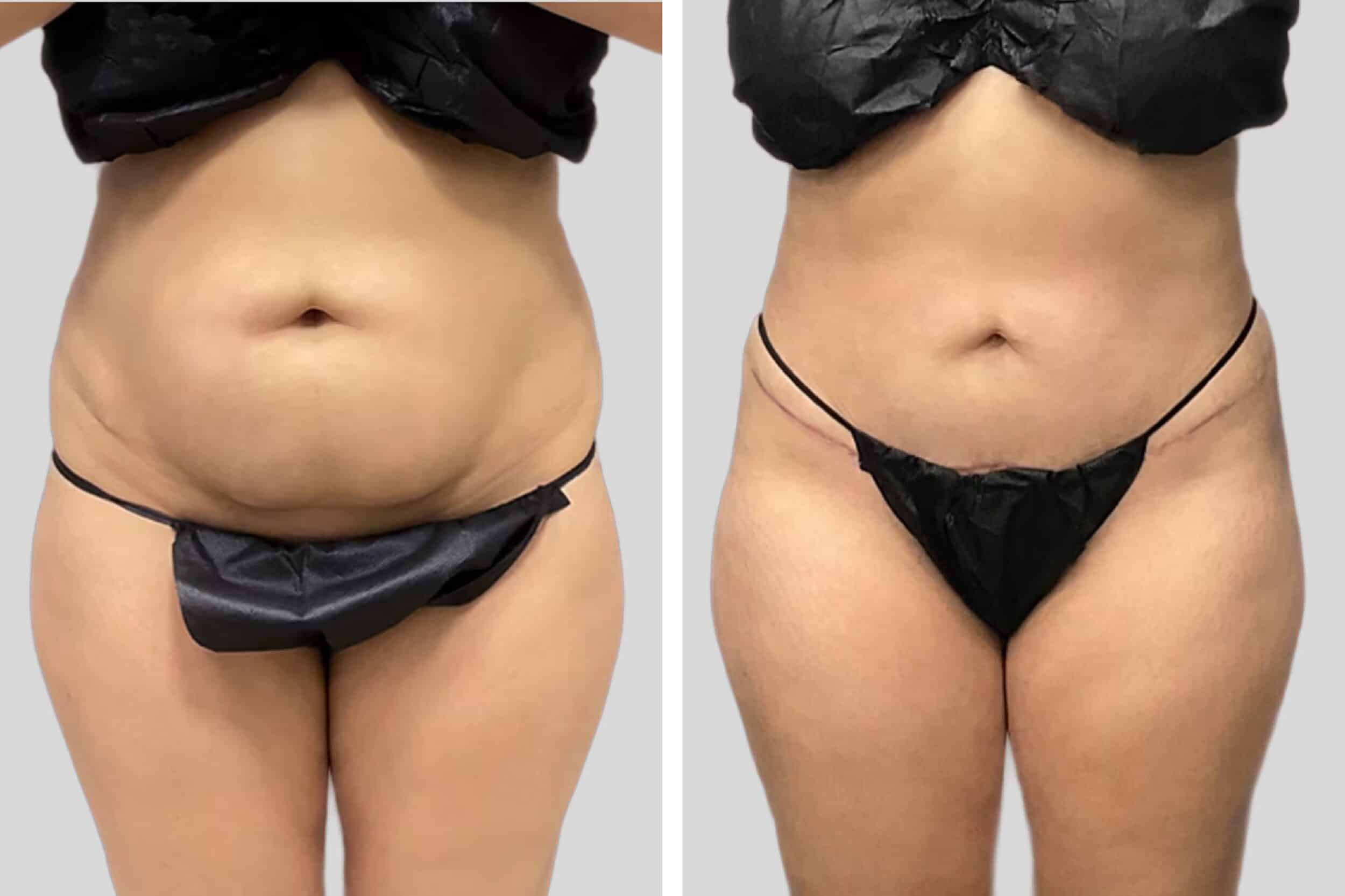 Before and After Image: Tummy Tuck - front