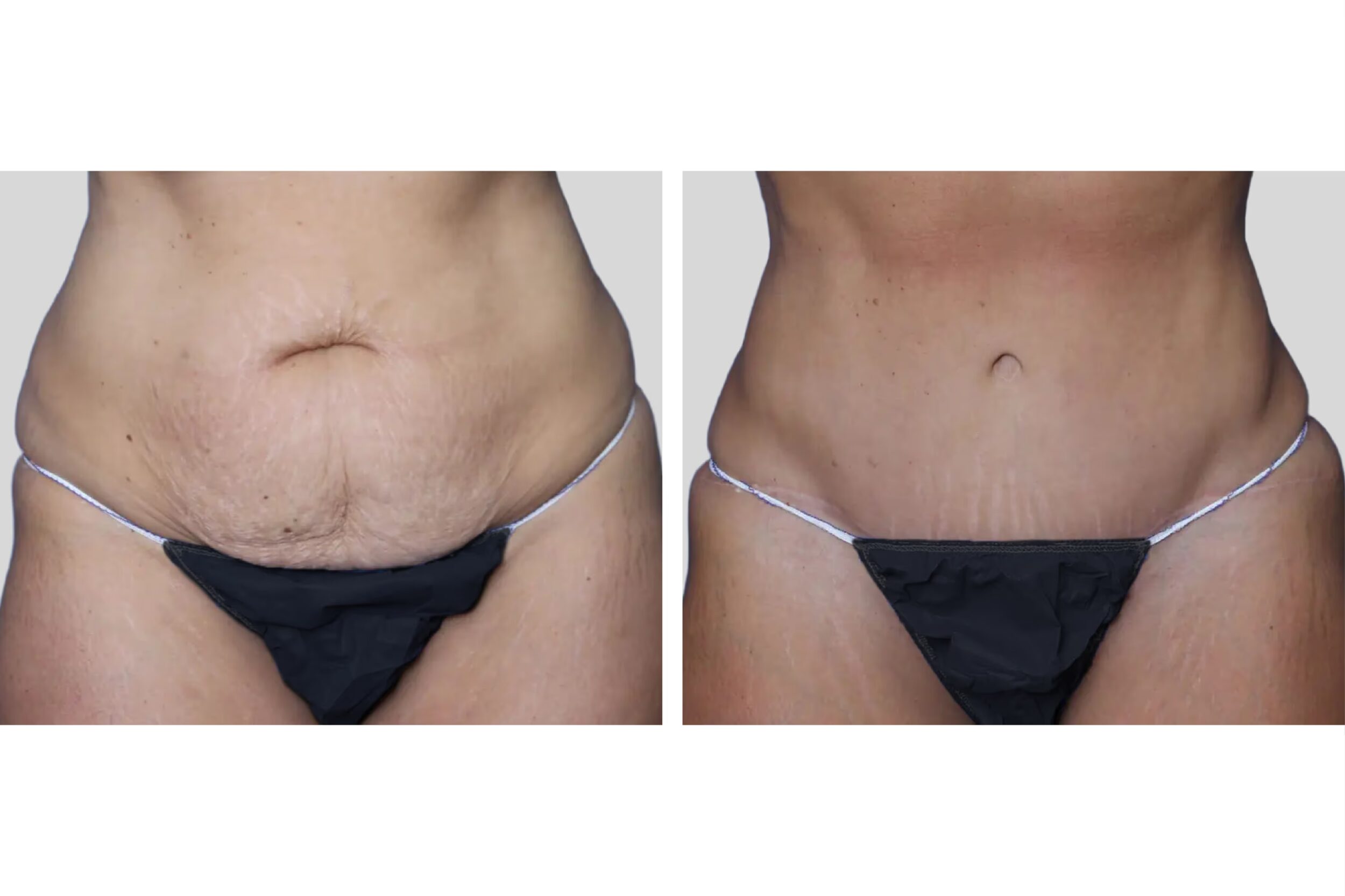 Before and After Image: Tummy Tuck - front