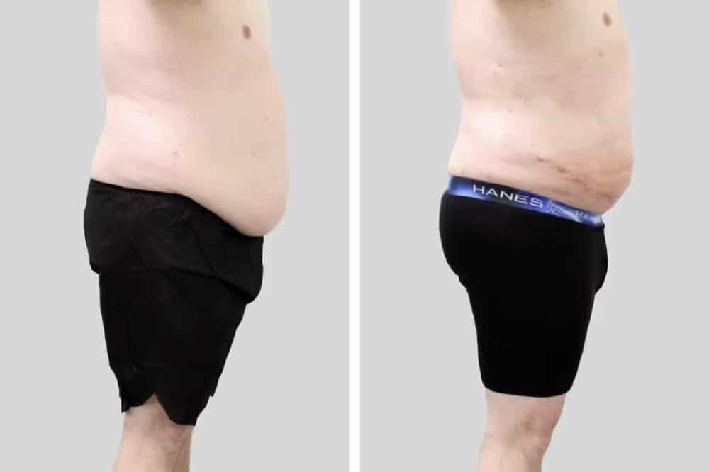 Before and After Image: Tummy Tuck - right-side
