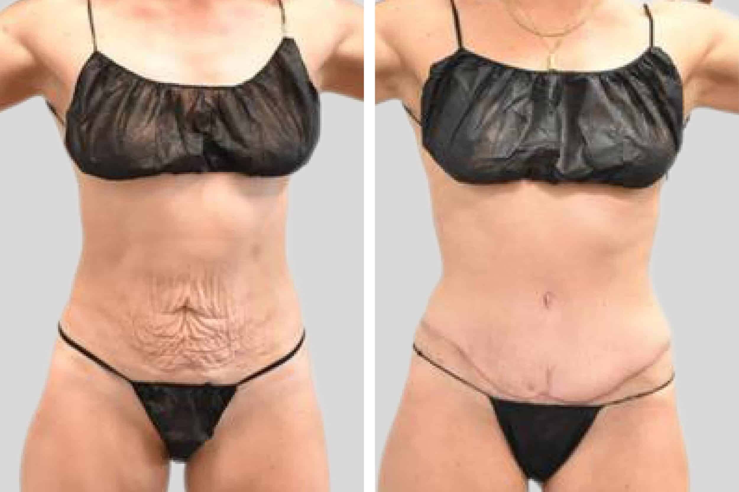 Before and After Image: Tummy Tuck - front