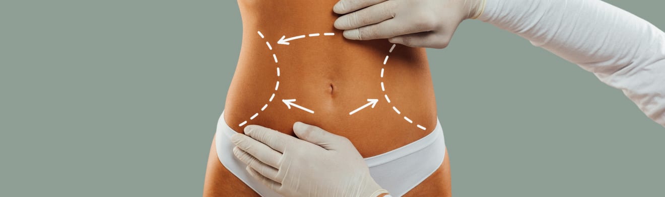 BelleSculpt 360 body contouring procedure illustration.