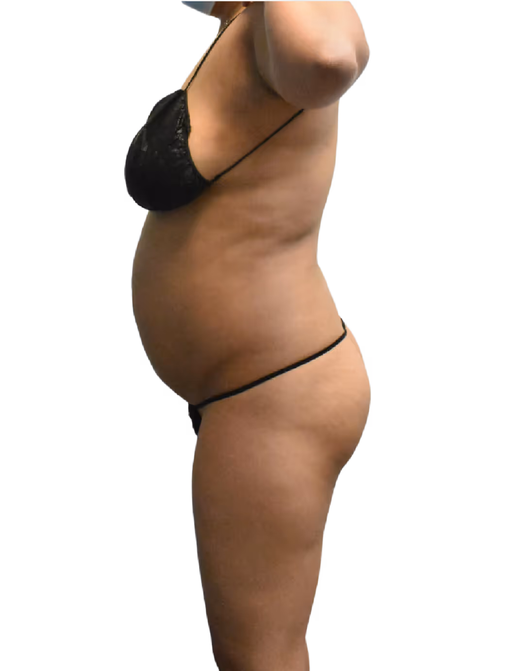 Before BelleSculpt 360 treatment