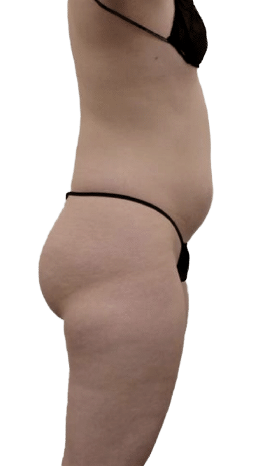 Brazilian Butt Lift in Utah & Idaho