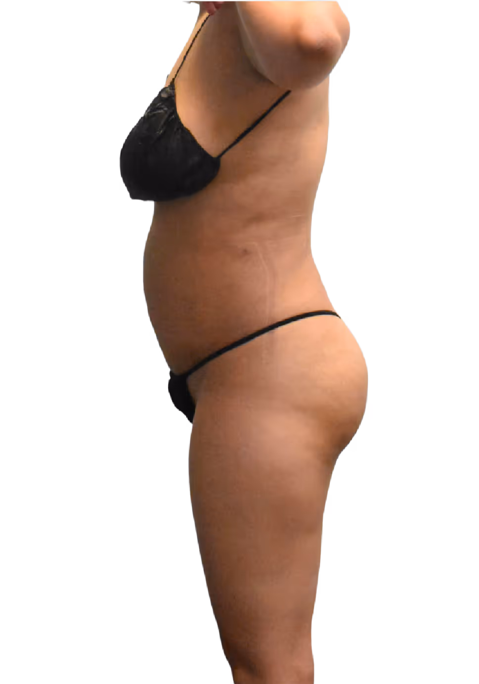 After BelleSculpt 360 treatment