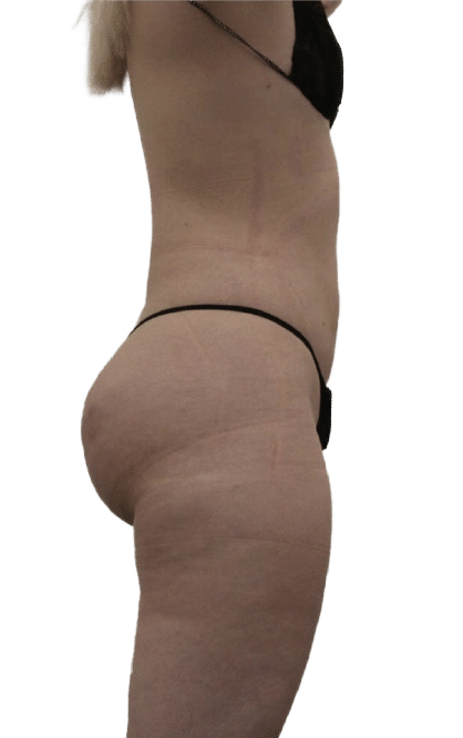 Brazilian Butt Lift in Utah & Idaho