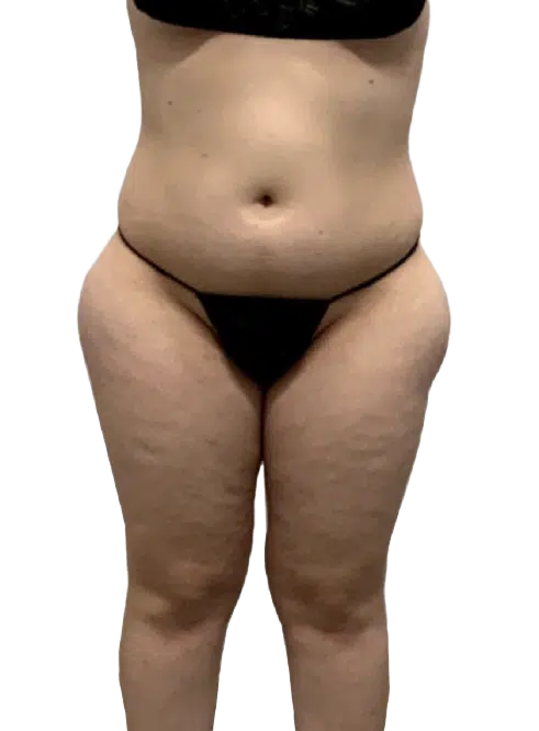Brazilian Butt Lift in Utah & Idaho