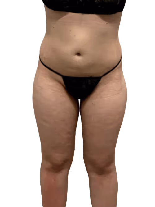 Brazilian Butt Lift in Utah & Idaho