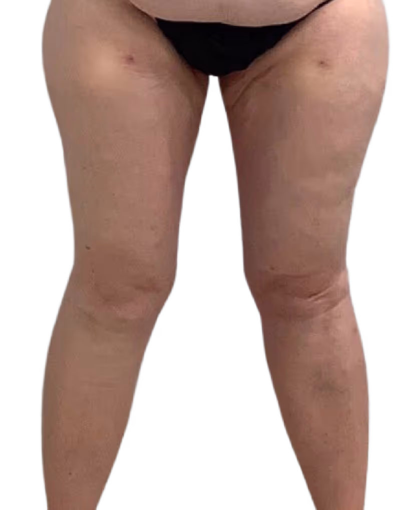 Brazilian Butt Lift in Utah & Idaho