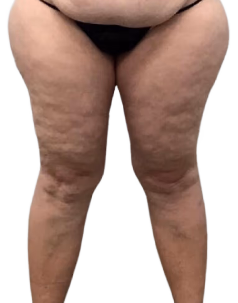 Brazilian Butt Lift in Utah & Idaho