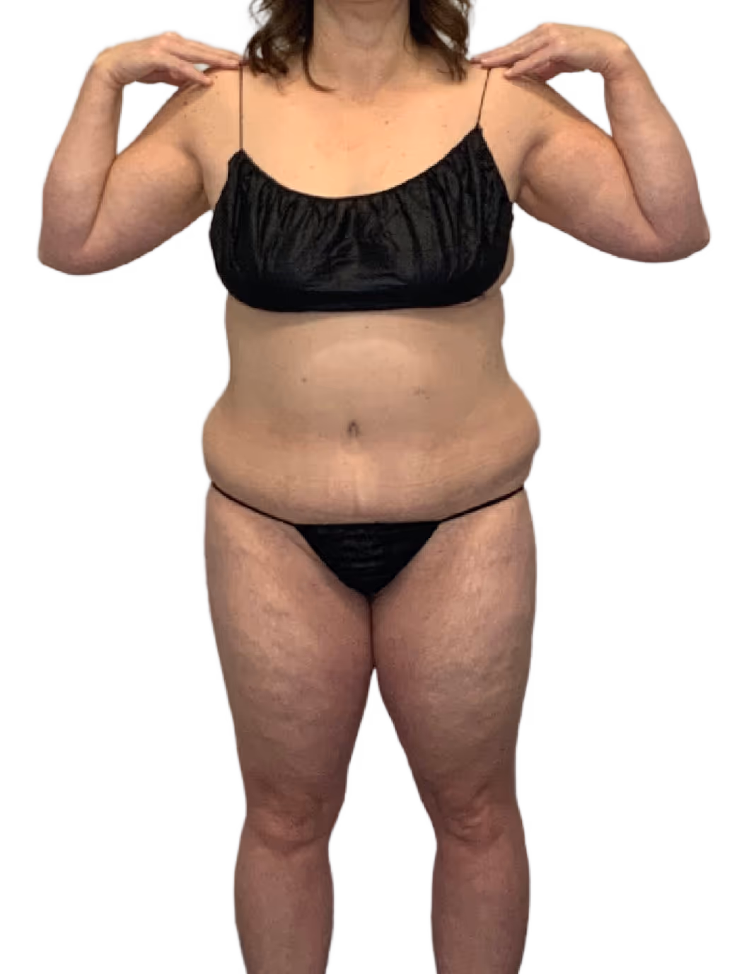Brazilian Butt Lift in Utah & Idaho