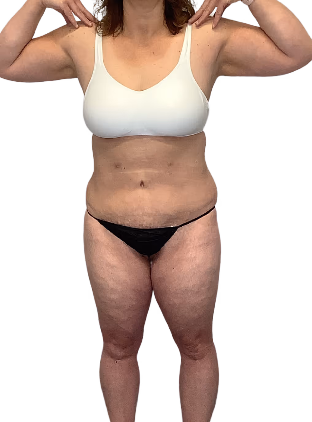 Brazilian Butt Lift in Utah & Idaho