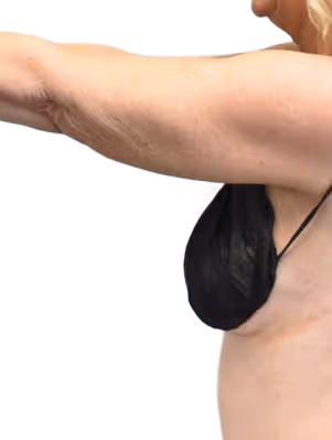 Brazilian Butt Lift in Utah & Idaho